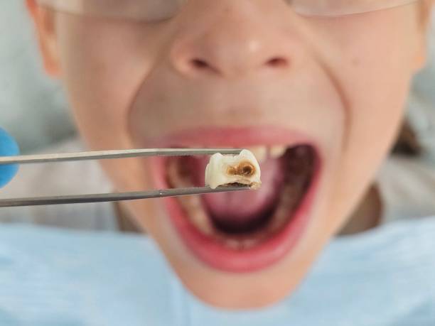 Best Broken or Cracked Tooth Emergency Dentist in Carolina Beach, NC